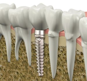 Implant Dentistry