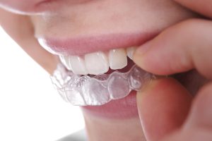 Straighten Your Smile with Confidence: The Benefits of Clear Aligners in Seminole, Florida