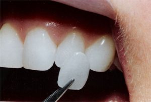 Dental Veneers